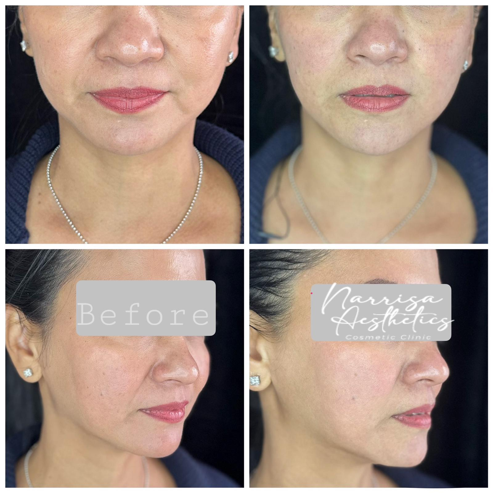 Narissa Aesthetic Cosmetic - Before and After
